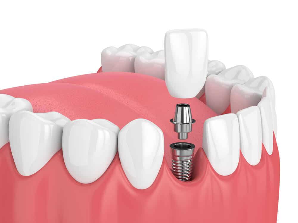 Dentist in McKinney Tx shows you a sample of dental implants