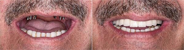 All on 4 near me mckinney dentist